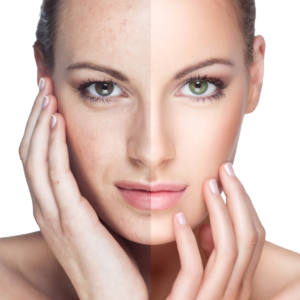Pre and Post Instructions for Ipl at Laser Skin Care Center