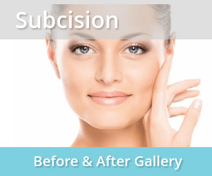 Subcision-before-and-after-image-gallery-laser-skin-care-center-long-beach-ca