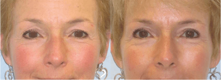 Lcs-blepharoplasty-results
