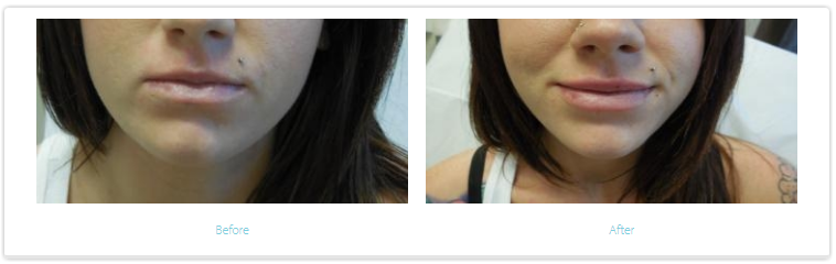 Lip Augmentation Before and After Photos