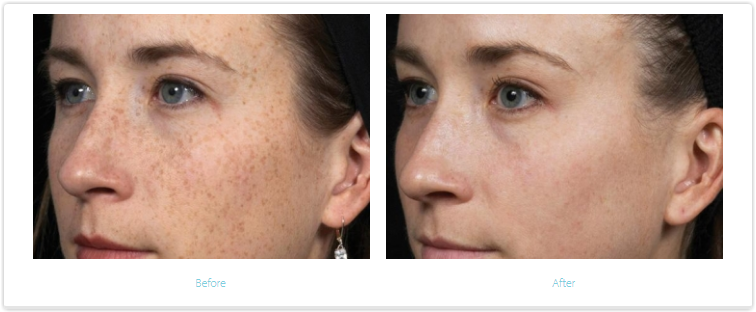 Melasma Before and After Treatment.