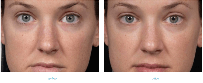 Clear and Brilliant Laser Treatment Long Beach