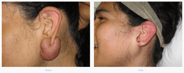 Earlobe repair & Piercing – Curves Cosmetic Surgery, Skin & Laser Clinic