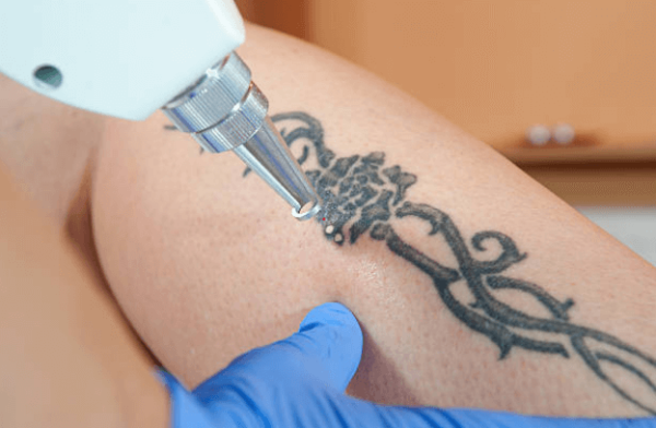 Laser Tattoo Removal Long Beach