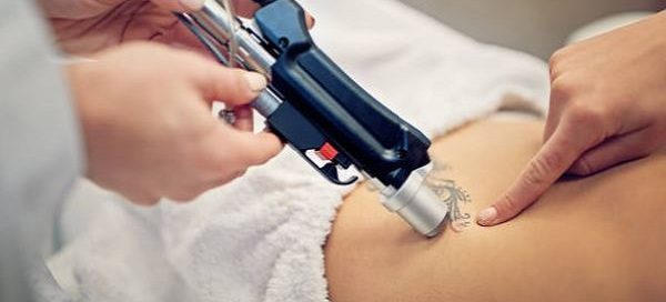 Long Beach Laser Tattoo Removal