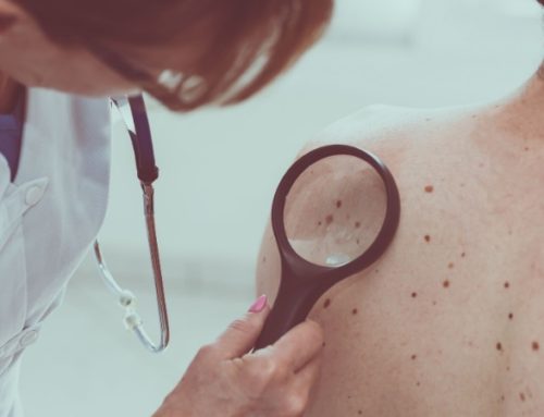 How To Know If You Have Skin Cancer
