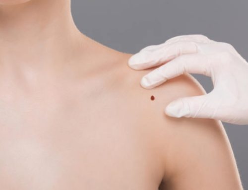 How Should You Treat Skin Cancer?