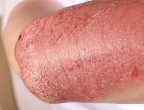 What Causes Psoriasis?