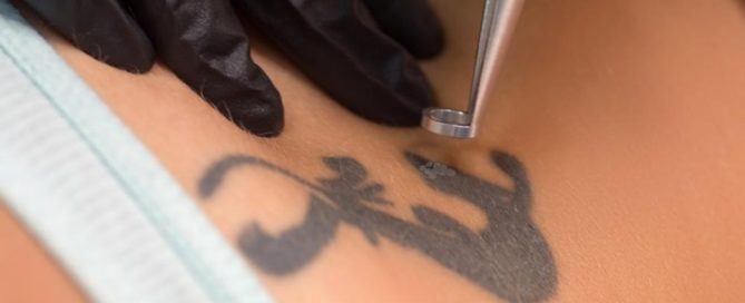 Long Beach Laser Tattoo Removal