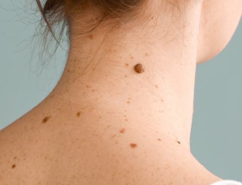 Skin Cancer Basics: Know Your ABCDEs
