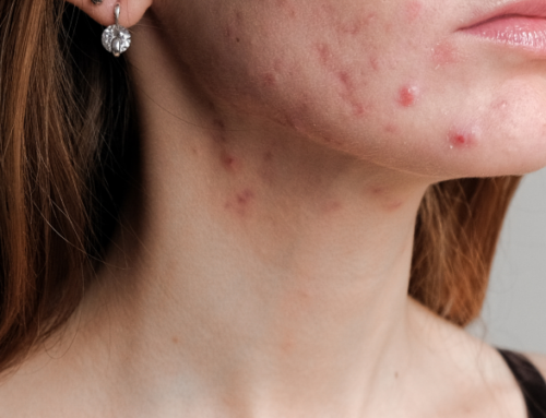 Understanding Adult Acne: Causes and Prevention Tips